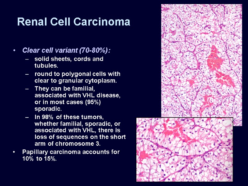 Renal Cell Carcinoma Clear cell variant (70-80%): solid sheets, cords and tubules. round to